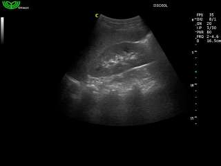 ECOCOLORDOPPER CHISON IVIS 60 EXPERT ECOGRAFO + 4D + SONDA CONVEX 